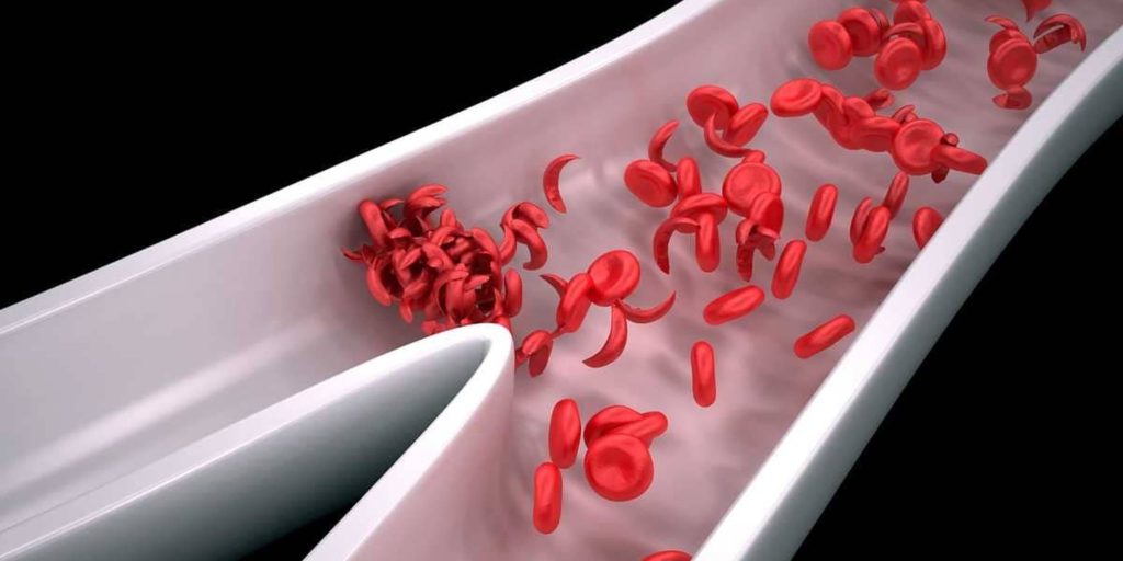أخيرًا هل تمكن العلماء من إيجاد علاج لفقر الدم المنجلي؟!