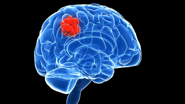 أورام الدماغ هي نمو غير طبيعي للخلايا داخل الدماغ.